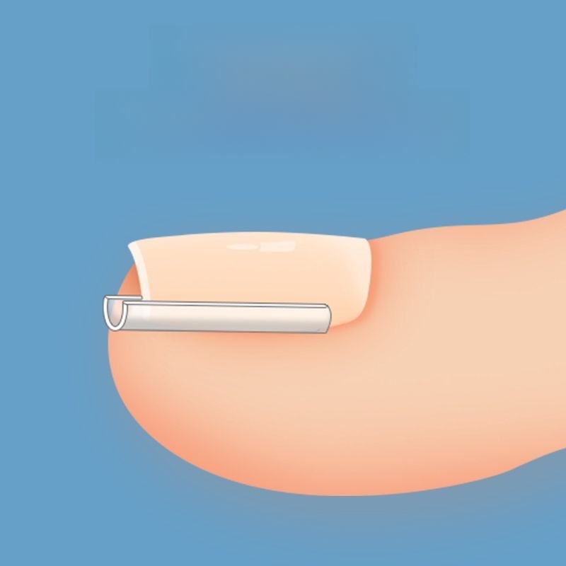 Special Toe Cover Infilled Pad Nail Buckle Isolation Patch